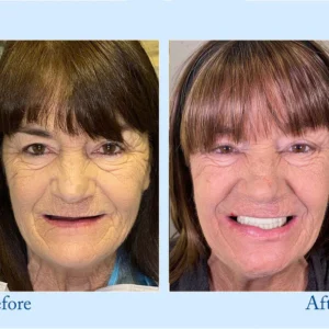 Hidone® Advanced Customized Full Denture Set