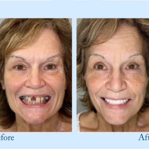 Hidone® Advanced Customized Full Denture Set