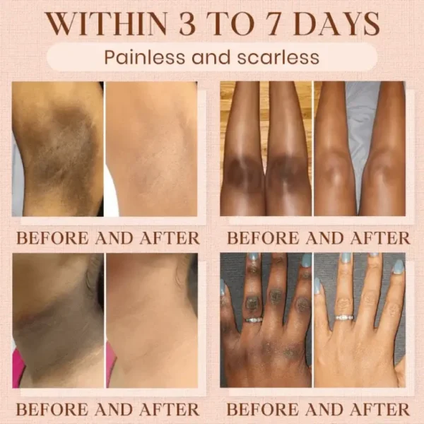 Luhaka®️ Purifying Exfoliating Gel for Acanthosis Nigricans