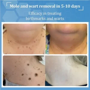 Zvoevo® BeeDerm RX Cream, Painless, Targeted Treatment for Warts