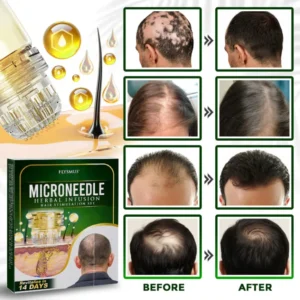 flysmus® Microneedle Herbal Infusion Hair Stimulation Set