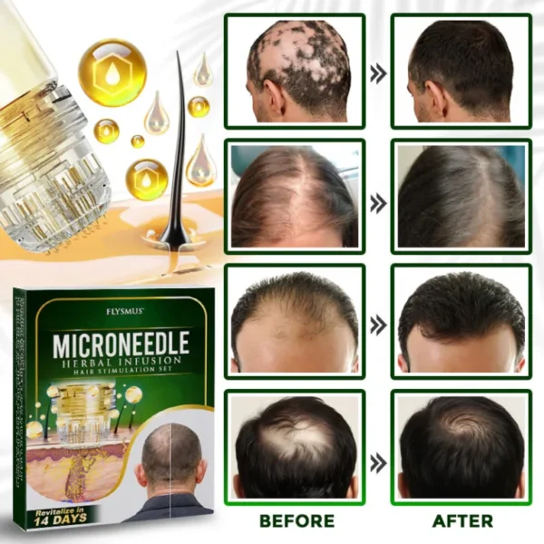flysmus® Microneedle Herbal Infusion Hair Stimulation Set